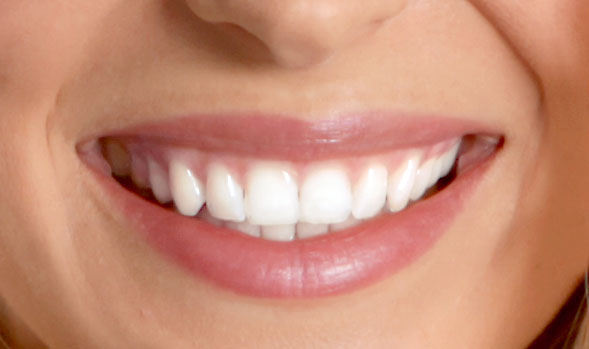 Zähne nach einer Zahnaufhellung