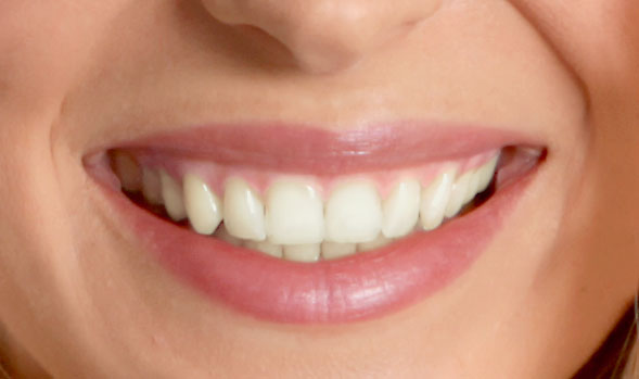 Zähne vor einer Zahnaufhellung